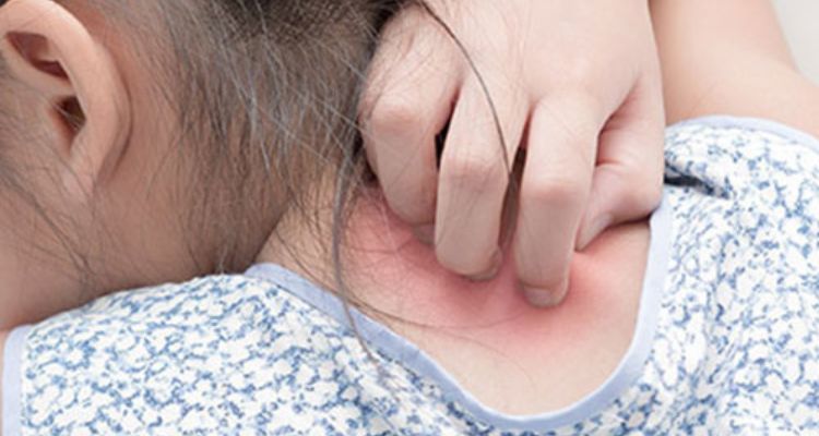 What can I spray on my mattress to kill scabies
