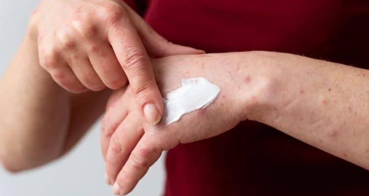 Toothpaste as a Home Remedy for Bed Bug Bites