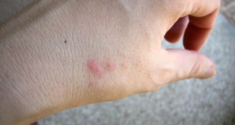 Bed Bug Bites Identifying