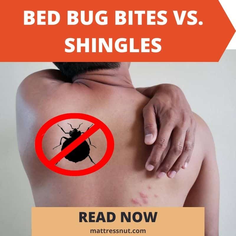 Bed Bug Bites vs. Shingles