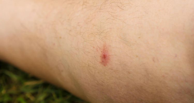 Gnat Bites